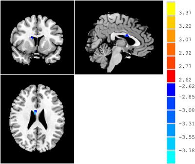 Abnormal regional homogeneity in right caudate as a potential neuroimaging biomarker for mild cognitive impairment: A resting-state fMRI study and support vector machine analysis